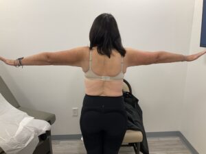 SmartLipo — after, patient 6