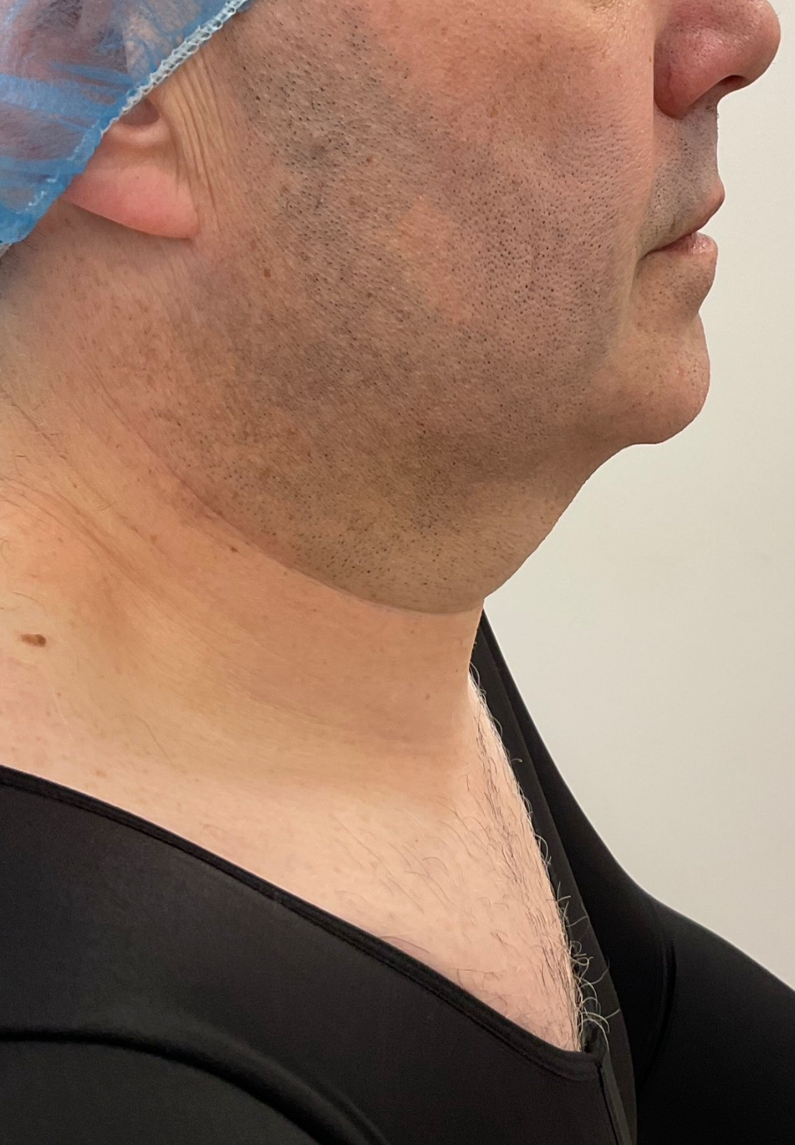 SmartLipo — before, patient 3