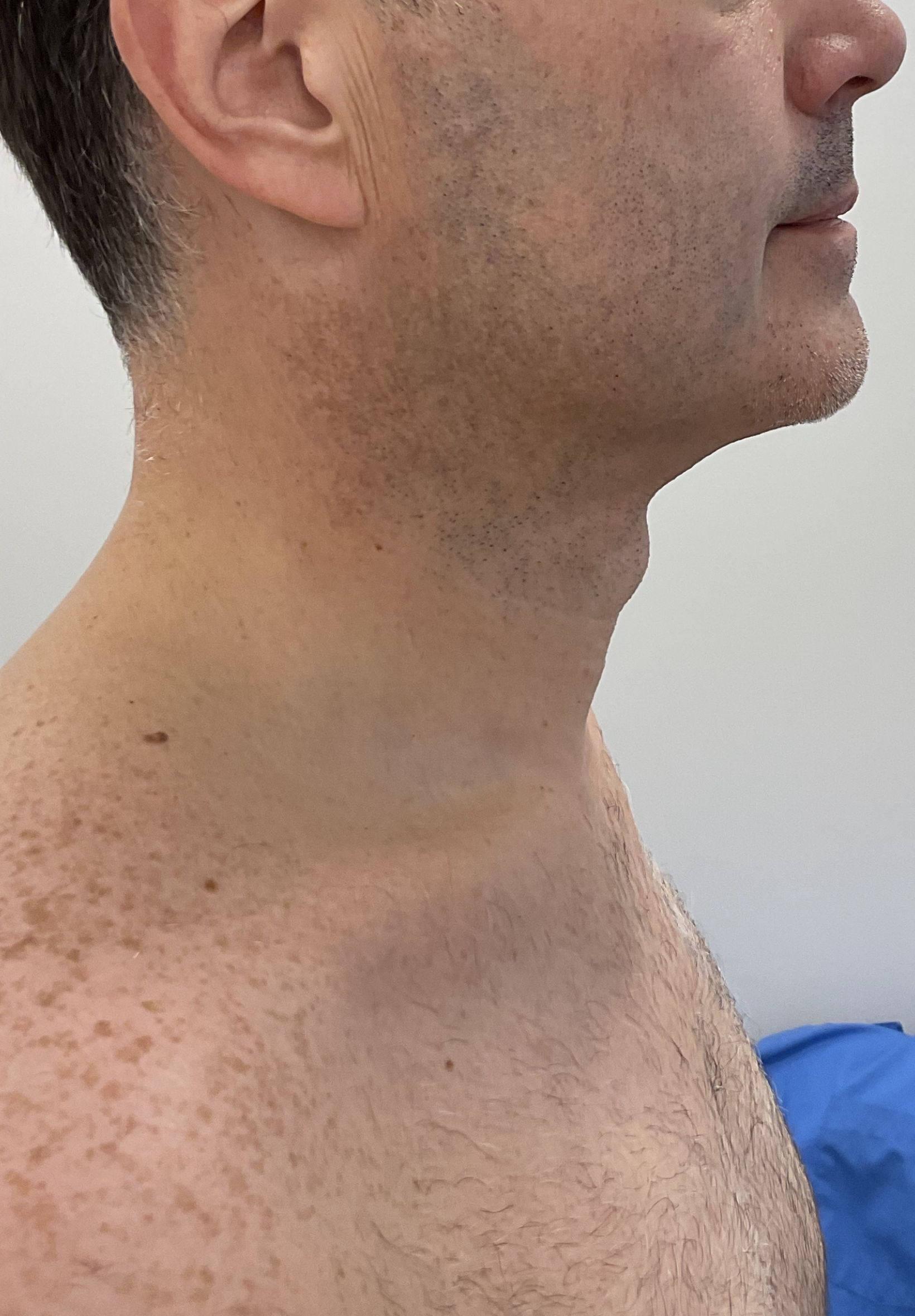 SmartLipo — after, patient 3