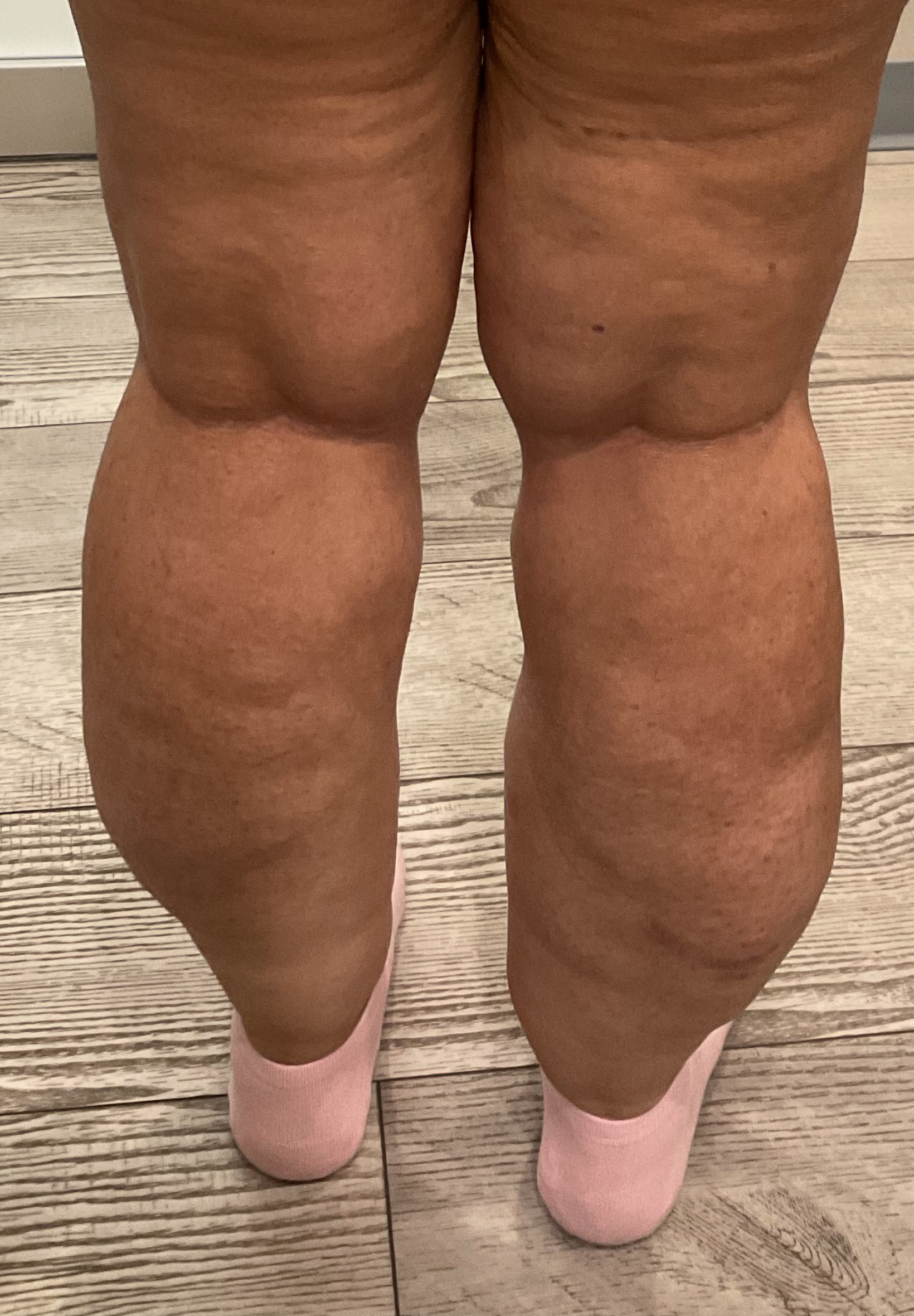 SmartLipo — before, patient 7